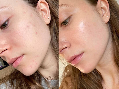 PEPTIDE-THERAPY